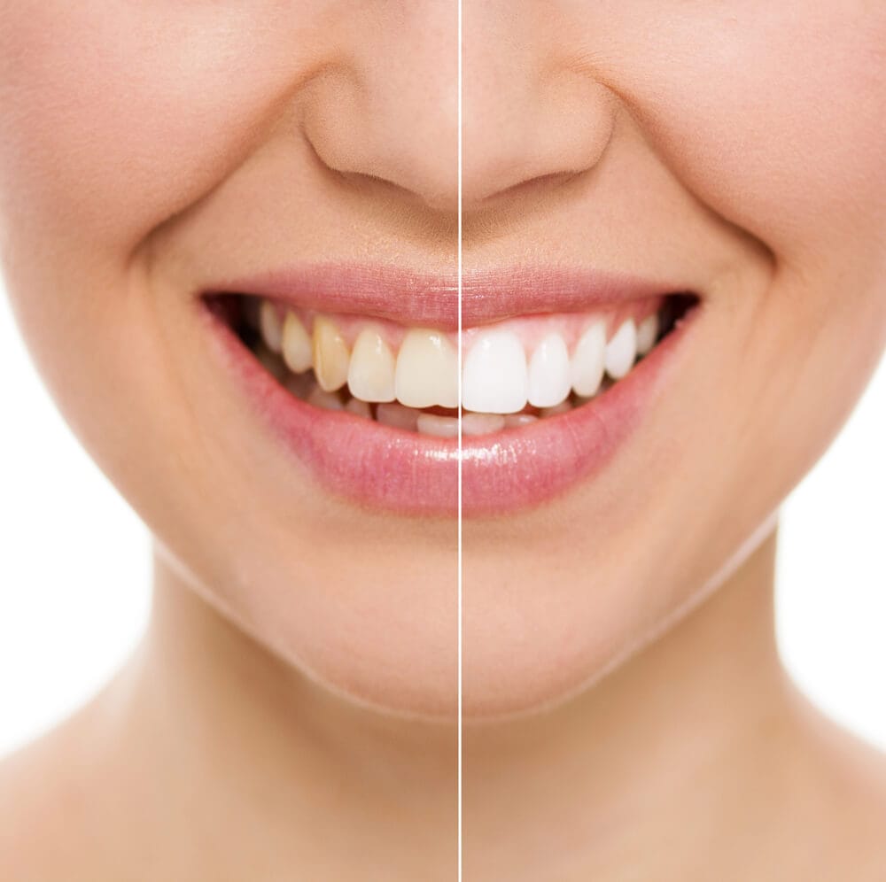 estetica-dentaria Branqueamento dentário